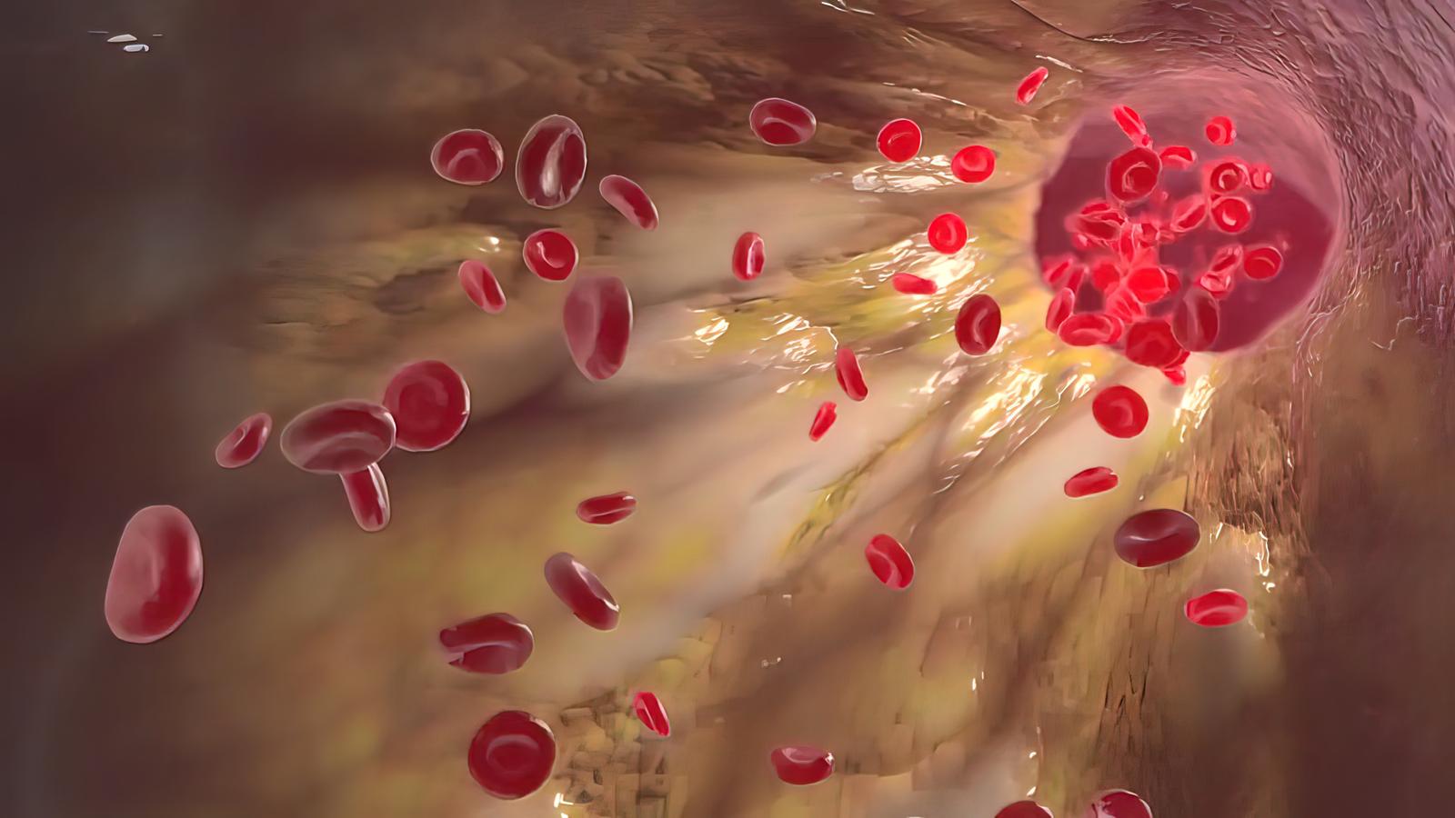 clogging of the arteries with plaque